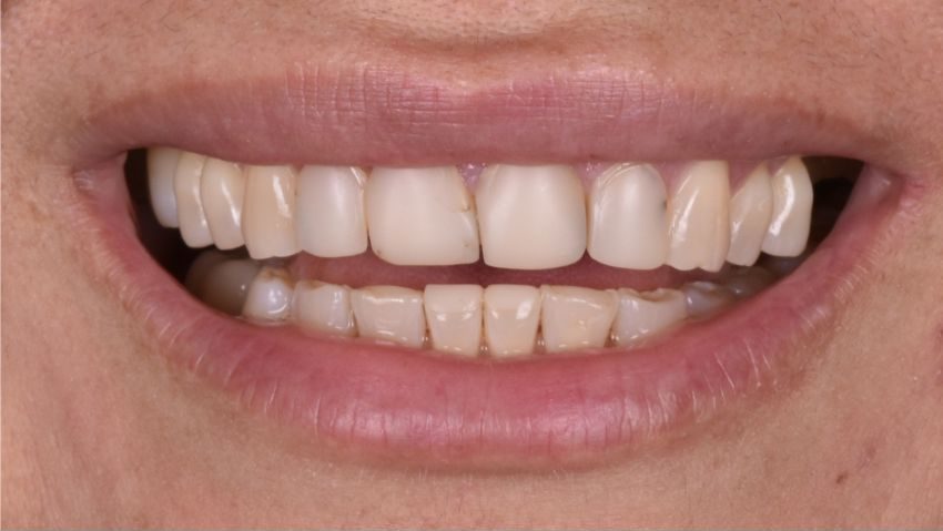 Before crowns, veneers and a bridge were used to restore this smile — No Limits Dental patient 1, Midtown Manhattan