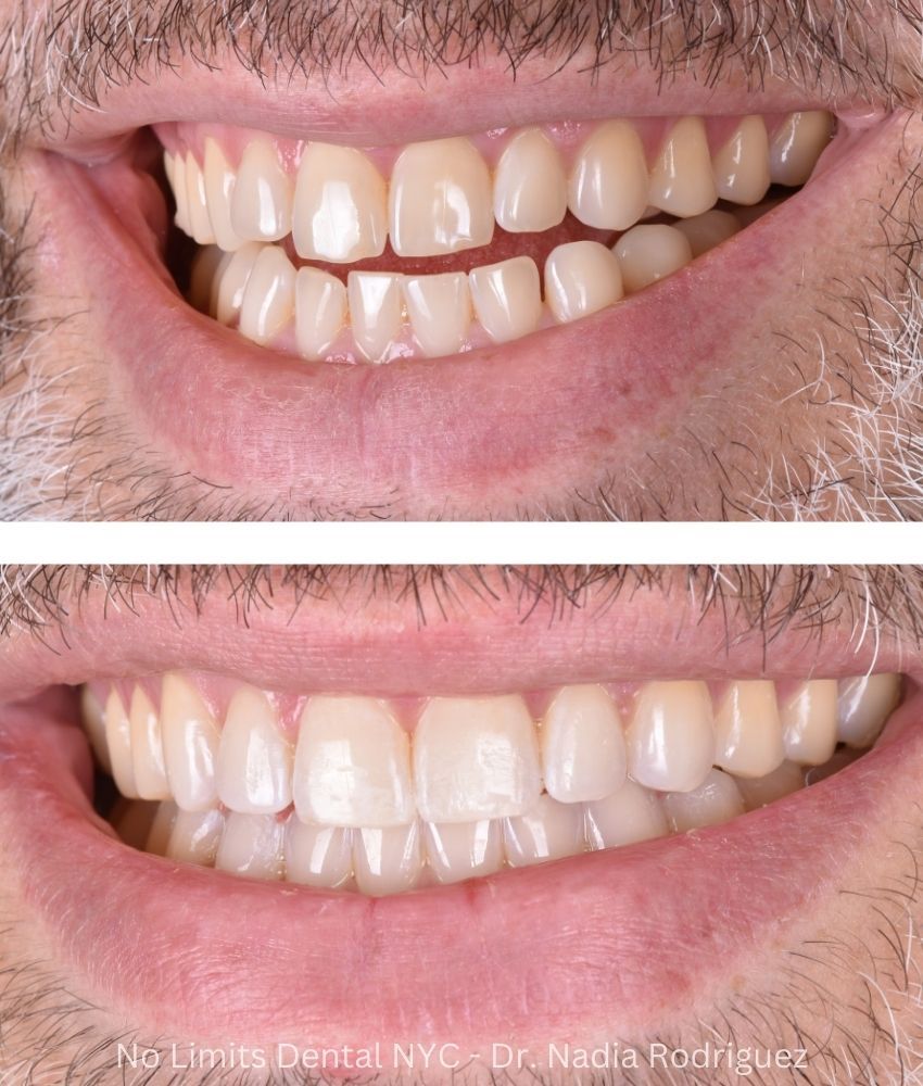 Additional photo 2, invisalign, bonding and enamel contouring were used to restore this smile — No Limits Dental patient 4