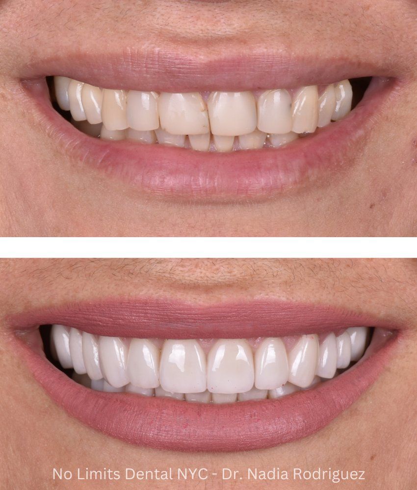 Additional photo 3, crowns, veneers and a bridge were used to restore this smile — No Limits Dental patient 1