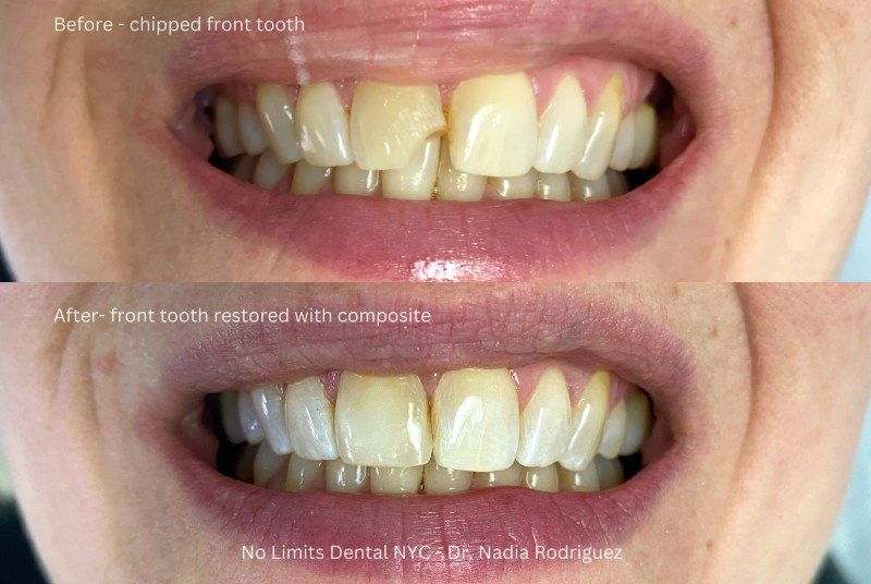 Chipped front tooth before and after being restored with tooth-colored composite at No Limits Dental