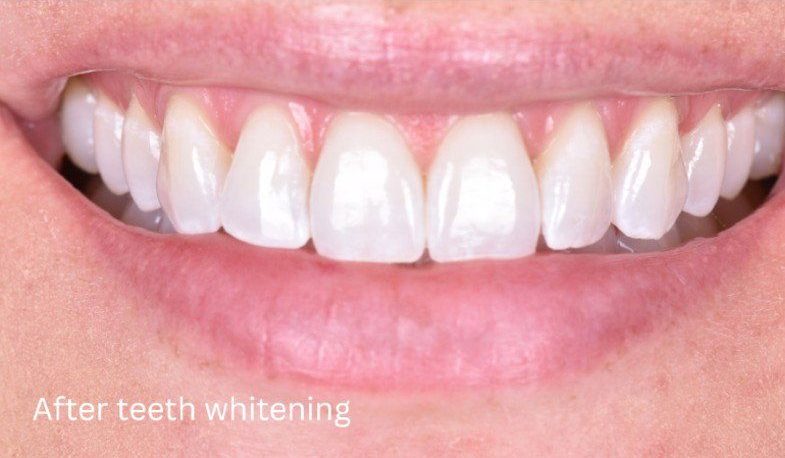 After teeth whitening — No Limits Dental patient 2, Midtown Manhattan
