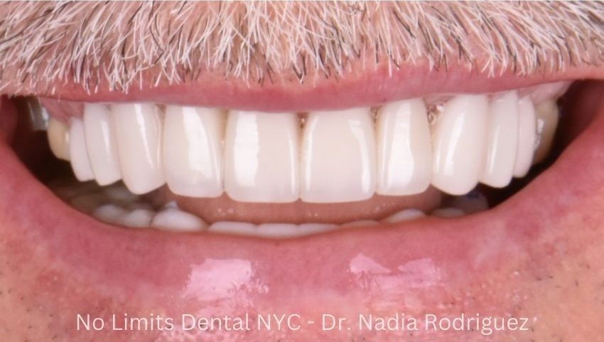 After porcelain crowns on the top and temporary crowns on the bottom were used to restore this smile — No Limits Dental patient 10, Midtown Manhattan