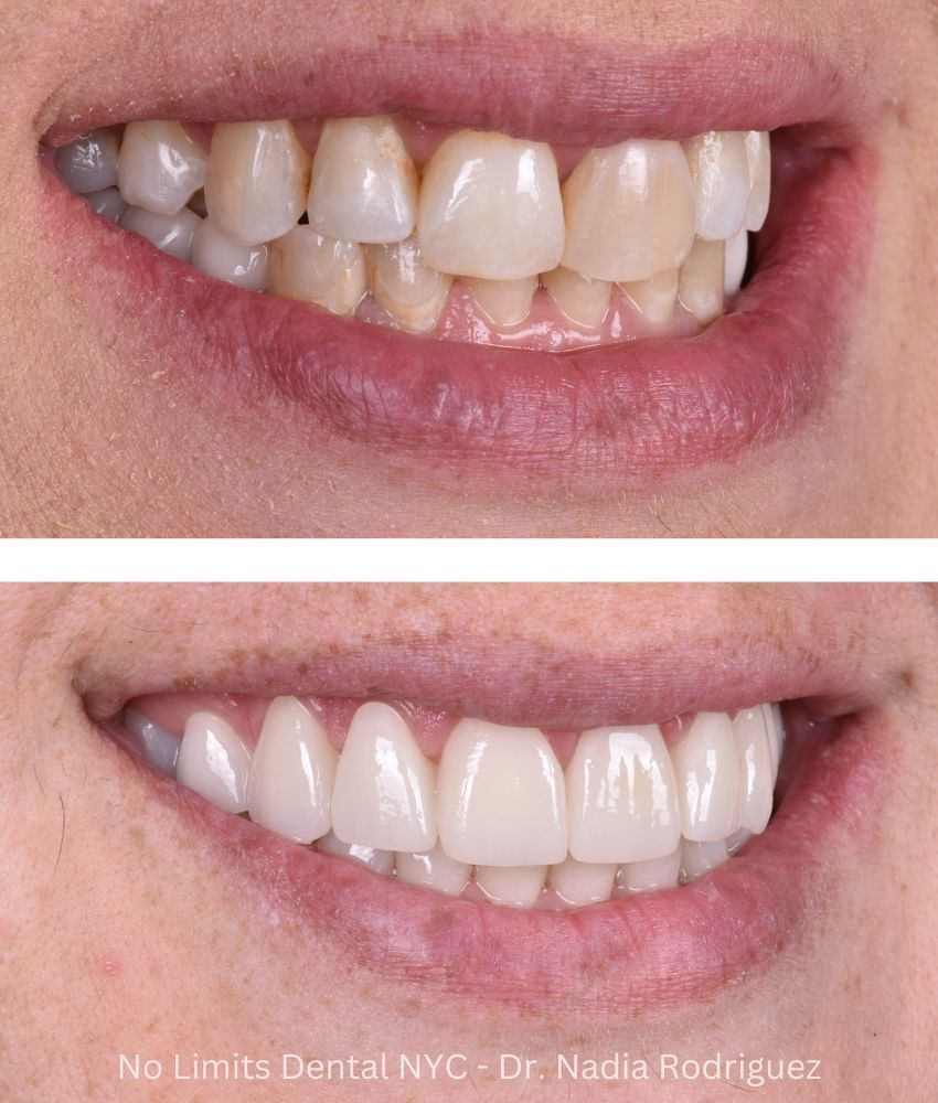 Additional photo 1, crowns were used to restore this smile — No Limits Dental patient 2