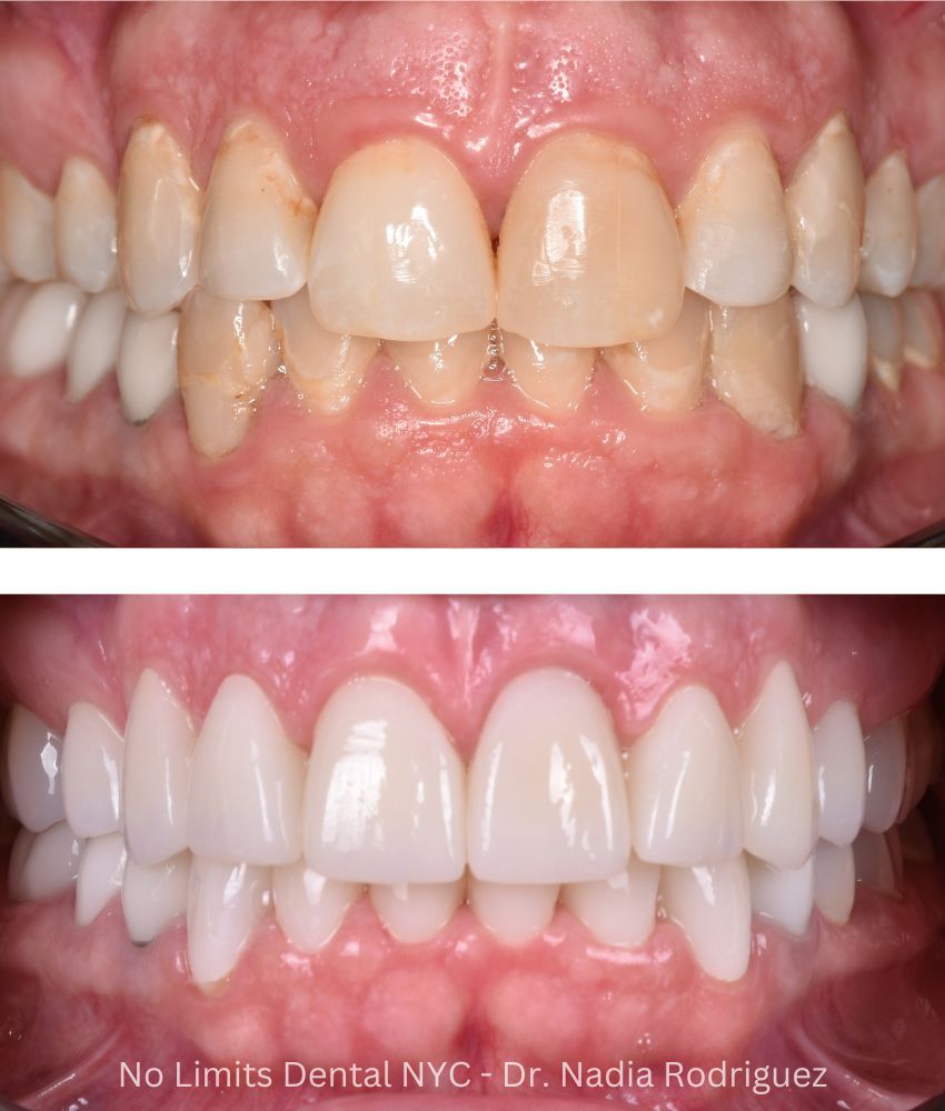 Additional photo 4, crowns were used to restore this smile — No Limits Dental patient 2