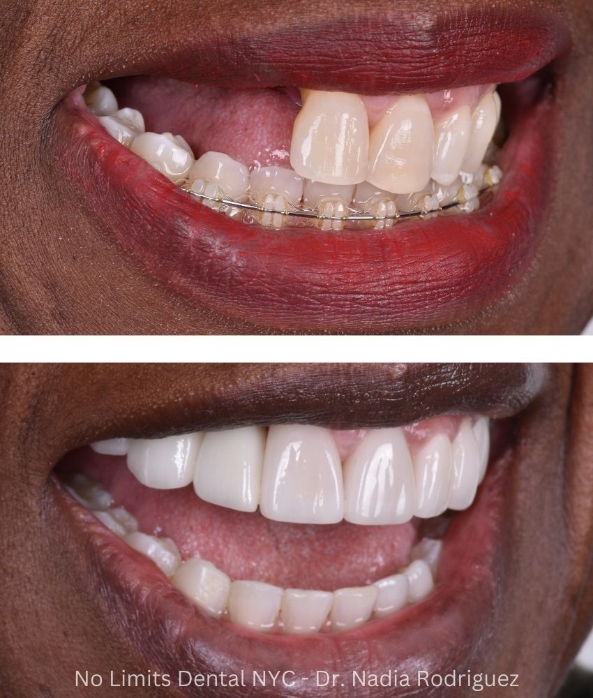 Additional photo 1, dental implants, crowns, and veneers were used to restore this smile — No Limits Dental patient 3