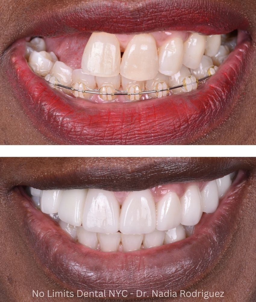 Additional photo 3, dental implants, crowns, and veneers were used to restore this smile — No Limits Dental patient 3
