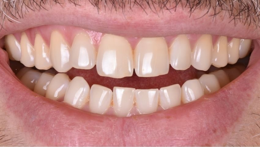 Before invisalign, bonding and enamel contouring were used to restore this smile — No Limits Dental patient 4, Midtown Manhattan