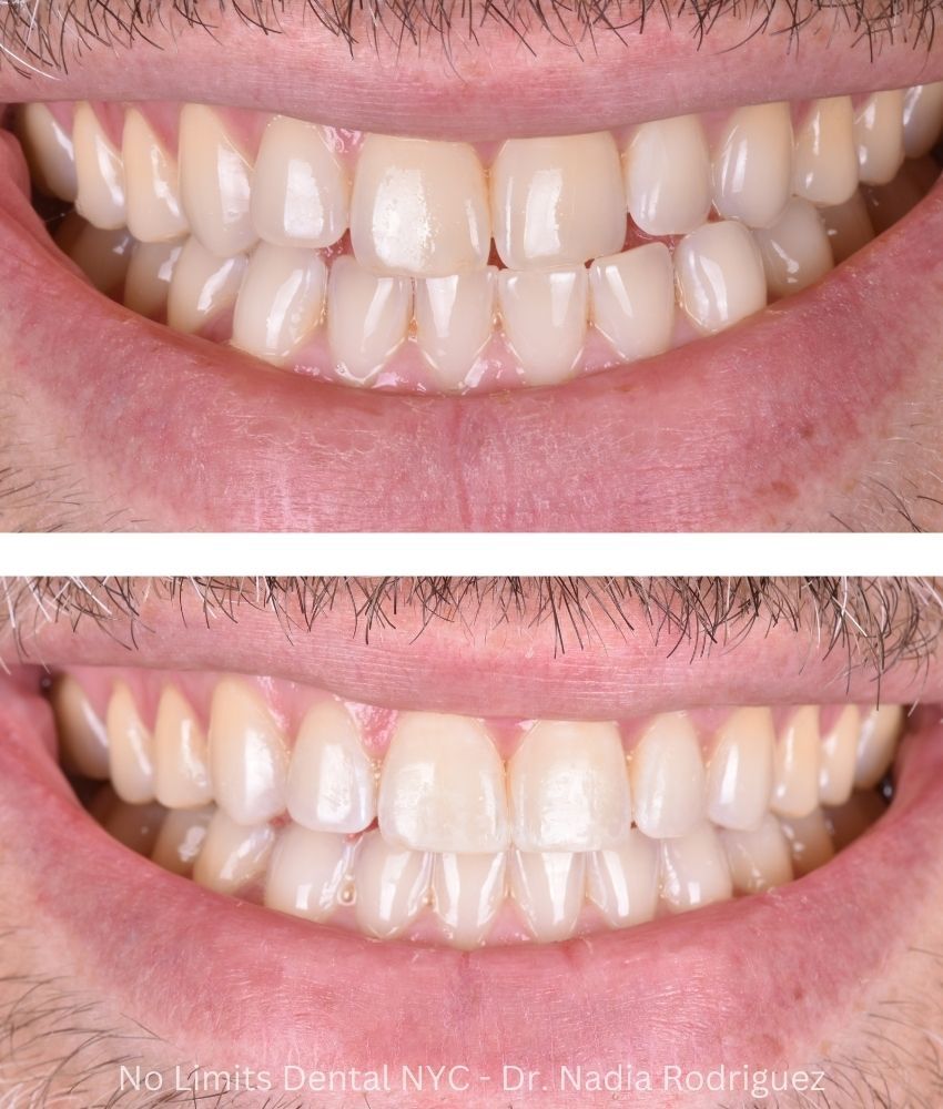 Additional photo 3, invisalign, bonding and enamel contouring were used to restore this smile — No Limits Dental patient 4