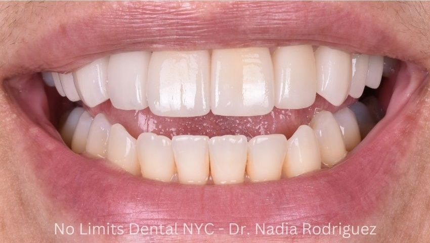 After invisalign, crowns, a bridge and implants were used to restore this smile — No Limits Dental patient 5, Midtown Manhattan