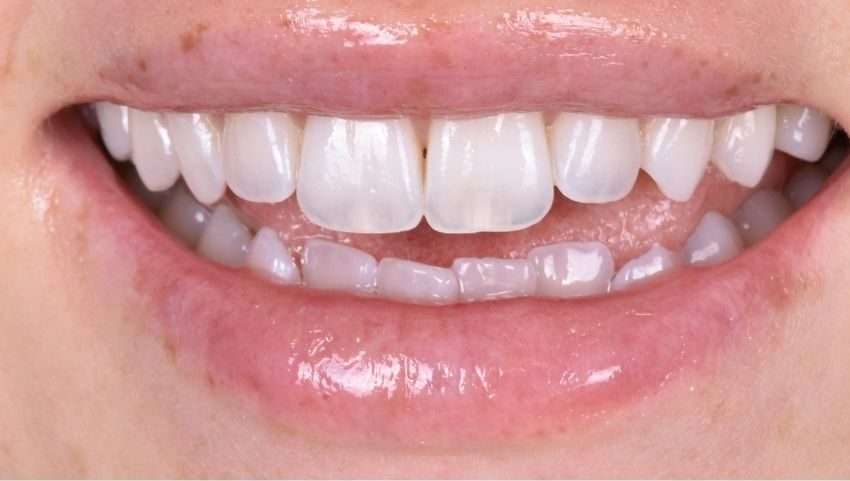 Before invisalign was used for 63 days on the bottom teeth to restore this smile — No Limits Dental patient 6, Midtown Manhattan