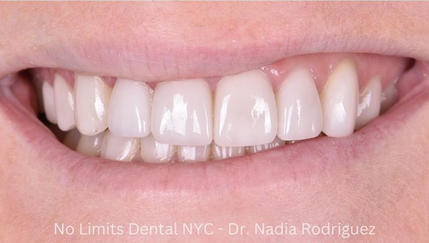 After crowns and veneers were used to restore this smile — No Limits Dental patient 9, Midtown Manhattan