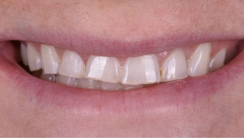 Before crowns and veneers were used to restore this smile — No Limits Dental patient 9, Midtown Manhattan
