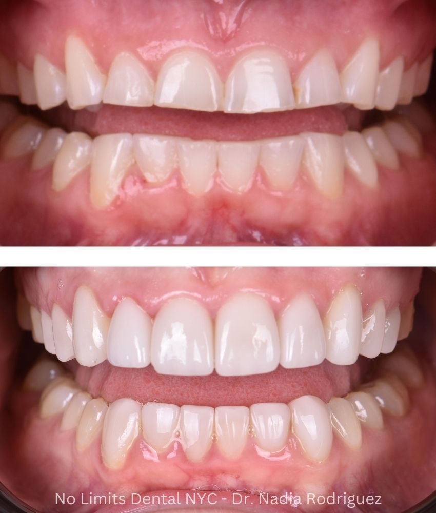Additional photo 1, crowns and veneers were used to restore this smile — No Limits Dental patient 9