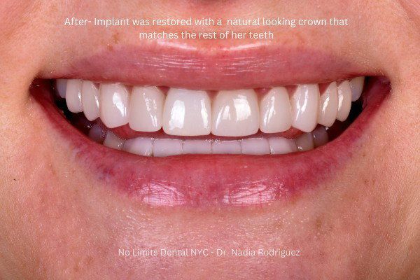 after implant