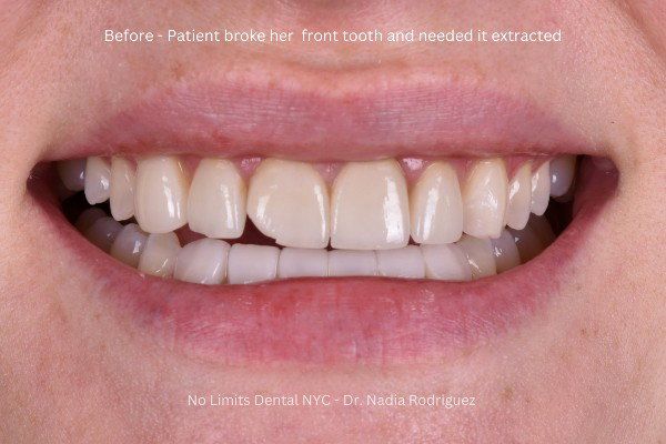 before implant