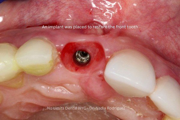 during implant