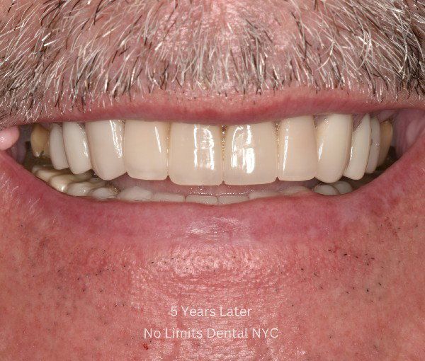 Porcelain crowns five years after placement, still natural-looking, No Limits Dental NYC
