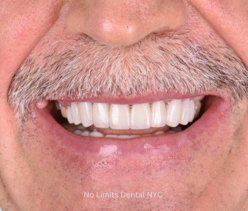 Retired detective's smile with new porcelain crowns on upper and lower teeth at No Limits Dental, Midtown Manhattan