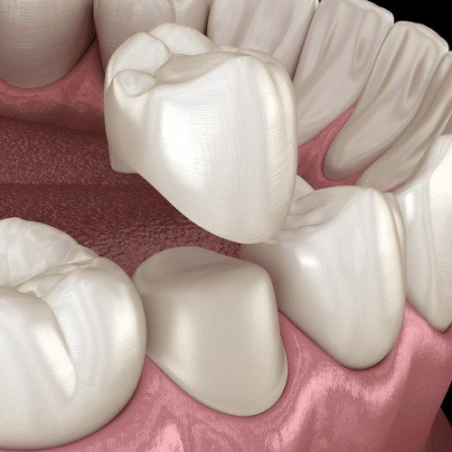 Porcelain dental crown