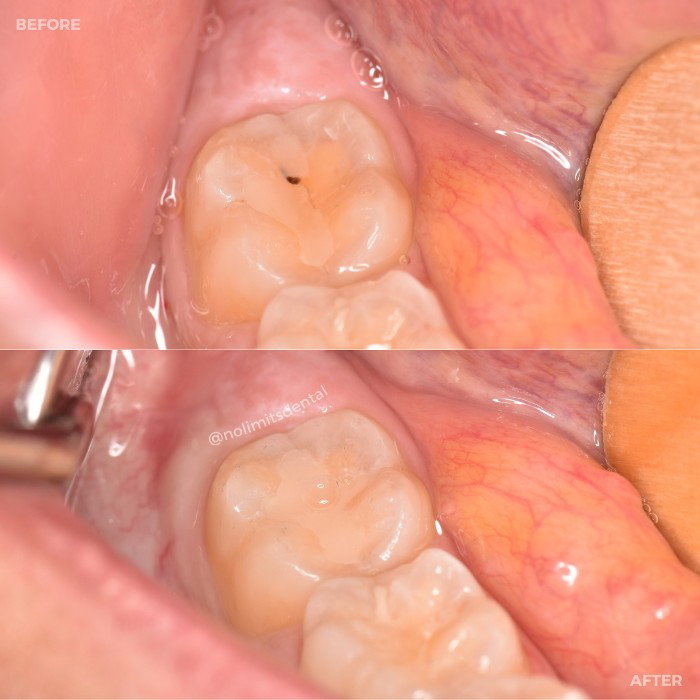 Tooth-colored filling before and after