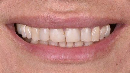 Before cosmetic dental work — No Limits Dental patient 1, Midtown Manhattan