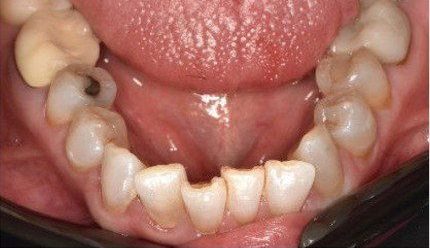 Before cosmetic dental work — No Limits Dental patient 4, Midtown Manhattan