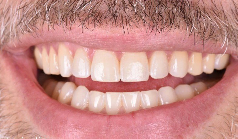 After Invisalign treatment — No Limits Dental patient 2, Midtown Manhattan