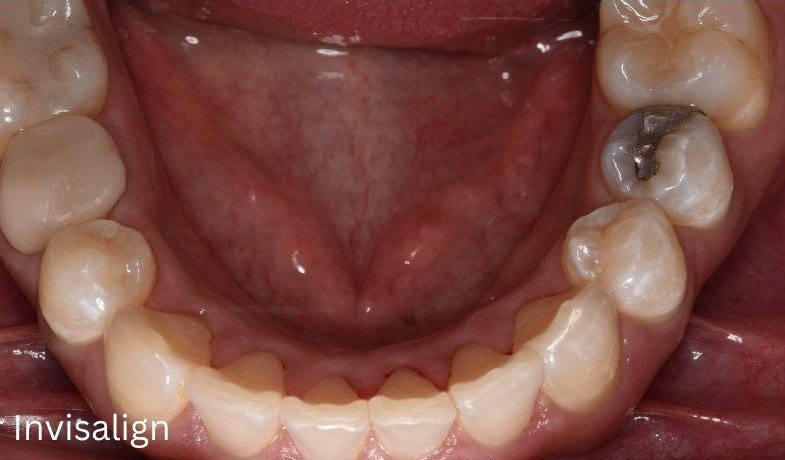 After Invisalign treatment — No Limits Dental patient 3, Midtown Manhattan