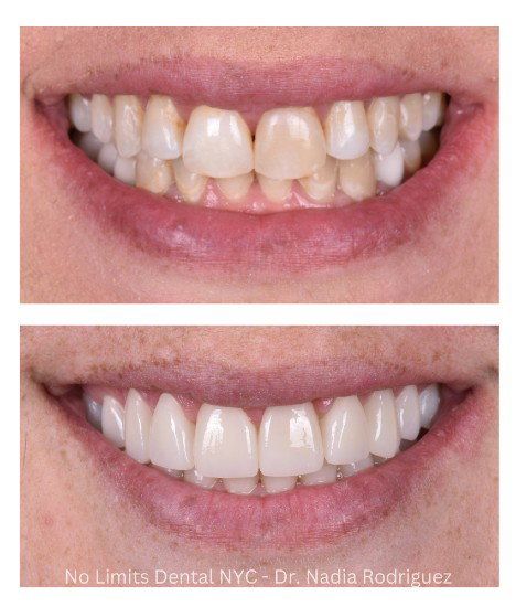 Smile makeover before and after: discolored, uneven front teeth restored with natural-looking porcelain