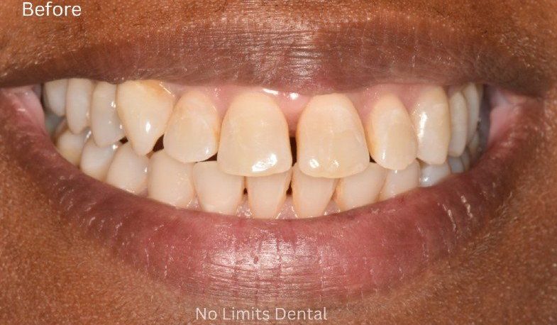 Before teeth whitening — No Limits Dental patient 1, Midtown Manhattan